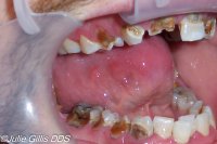 Meth-Mouth-1-of-3-1.jpg
