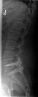 After Back surgery 2 DEC. 2009.JPG