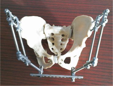 Pelvic Fixator.jpg